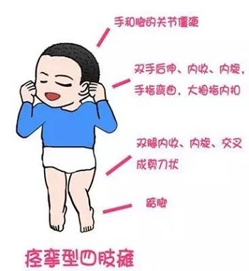 脑瘫患儿家长最关心的问题